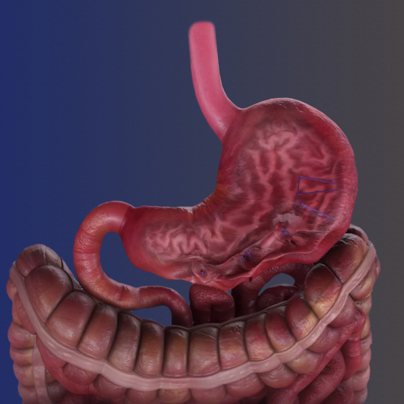 gastroplastia-endoscopica-secundário